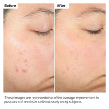 Cargar imagen en el visor de la galería, SALICYLIC ACID 2% EXFOLIATING BLEMISH SOLUTION
